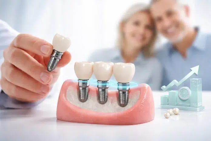 Screwless Dental Implants crown placement after healing and osseointegration